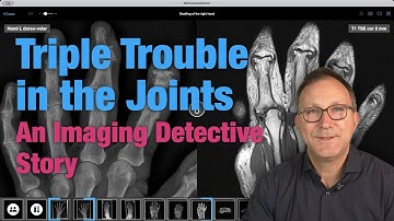 Triple Trouble in the Joints: How Imaging Solved an 87-Year-Old’s Mystery