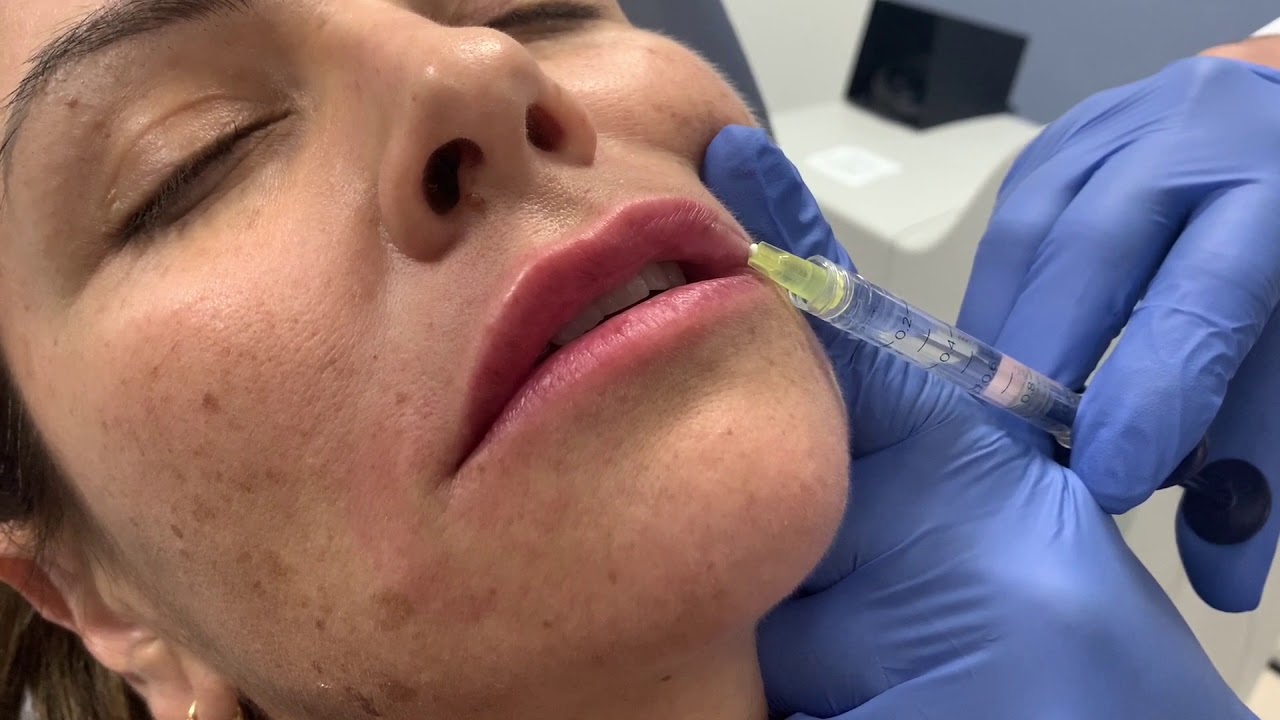 Lip filler treatment using latest FDA approved lip filler, Restylane Kysse | Dr. Shaun Patel