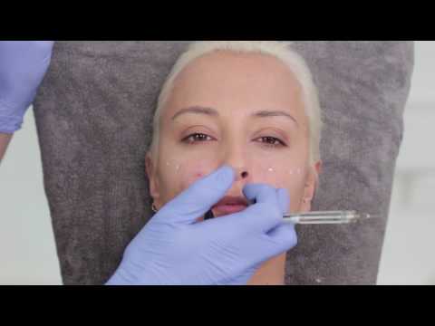 Video: ❶ Radiolifting - Schönheit Ohne Injektionen