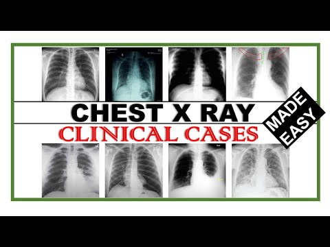 Chest X Ray Clinical Cases How to read Chest X Ray Dr Asif Lectures