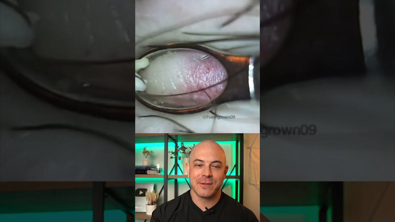 Doctor Reacts To Super Satisfying Popping Ingrown Hair Dermreacts Doctorreacts Ingrownhair