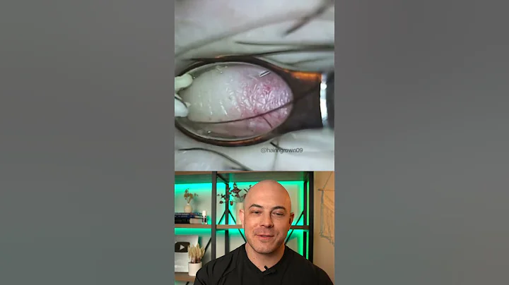 Doctor reacts to super satisfying popping ingrown hair! #dermreacts #doctorreacts #ingrownhair