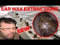 Ear Wax Removal: OMG! SATISFYING Ear Wax Removal. WATCH THIS!