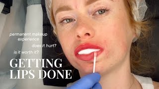 I Got My Lips Done: Painful or Perfect? Watch My Huge Transformation | VLOG