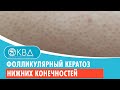 🦵🦵 Фолликулярный кератоз нижних конечностей. Клинический случай №623