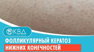 🦵🦵 Фолликулярный кератоз нижних конечностей. Клинический случай №623