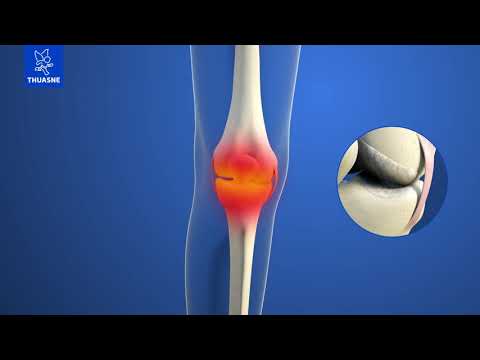 Vidéo: Association Du Désalignement, Du Dysfonctionnement Musculaire, De La Proprioception, Du Laxisme Et De La Charge Articulaire Anormale à L'arthrose Tibio-fémorale Du Genou - Une