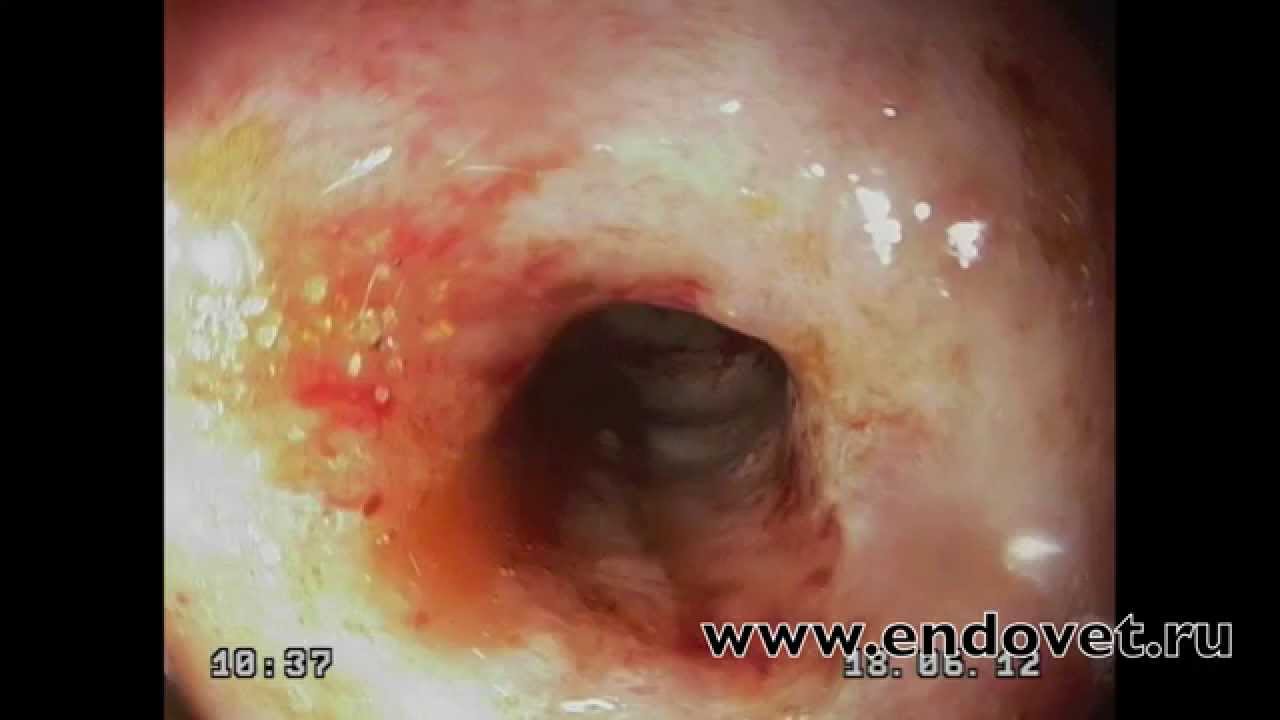 Endoscopic dilatation of the esophageal stricture - YouTube