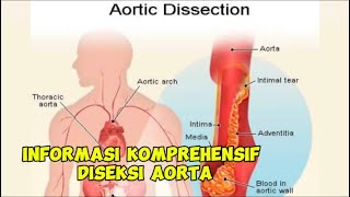 Diseksi aorta || penyebeb,gejala,diagnosis,pengobatan,komplikasi,pencegahan dan jenis direksi aorta.