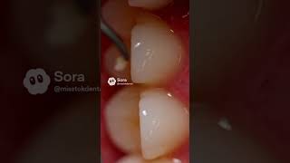 EXTREME TARTAR Removal 😳 | Deep Dental Cleaning Up Close!
