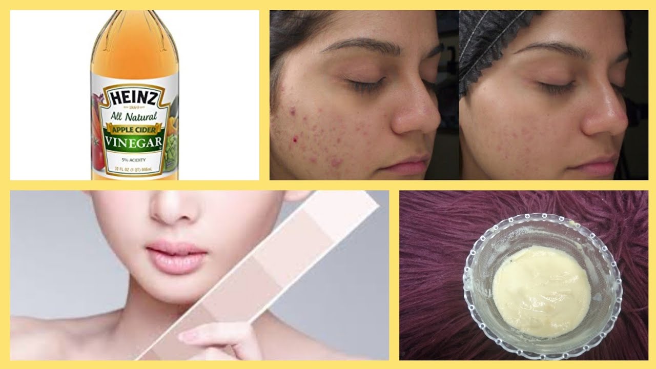 Apple vinegar skin whitening + glowing mask |pimples remove |acne spots