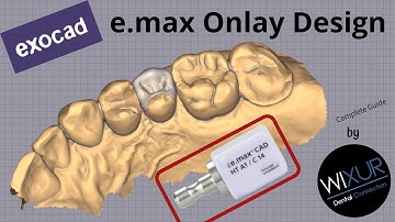 exocad e.max Onlay Design