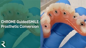 CHROME GuidedSMILE Prosthetic Conversion Process