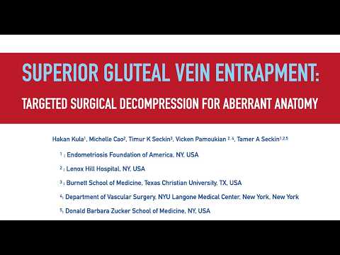 Superior Gluteal Vein Entrapment: Targeted Surgical Decompression for Aberrant Anatomy