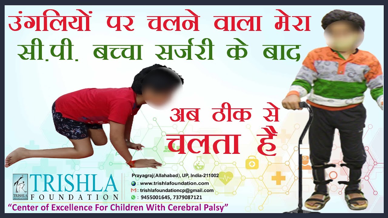 Cerebral Palsy child who can't crawl, started walking after treatment