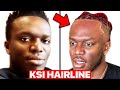 Hair Surgeon Reacts to KSI Hairline