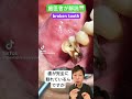 まっぷたつの歯🦷#虫歯 #歯根破折 #歯が欠けた #歯が割れた #治療 #根管治療 #おすすめ #口腔外科 #抜歯 #歯医者 #歯根嚢胞