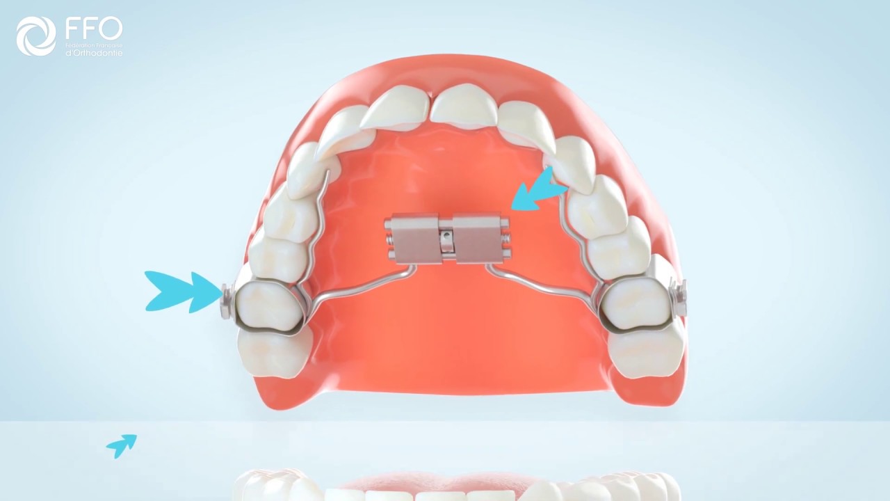 Le traitement orthodontique chez l'adulte : différents appareillages  proposés au cabinet d'orthodontie