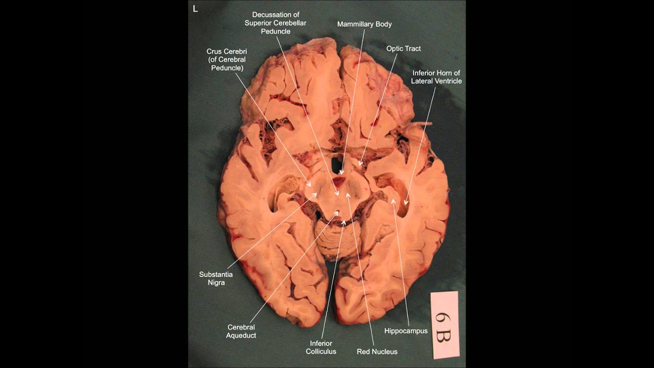 Neuroanatomy - Horizontal Brain Slices - YouTube