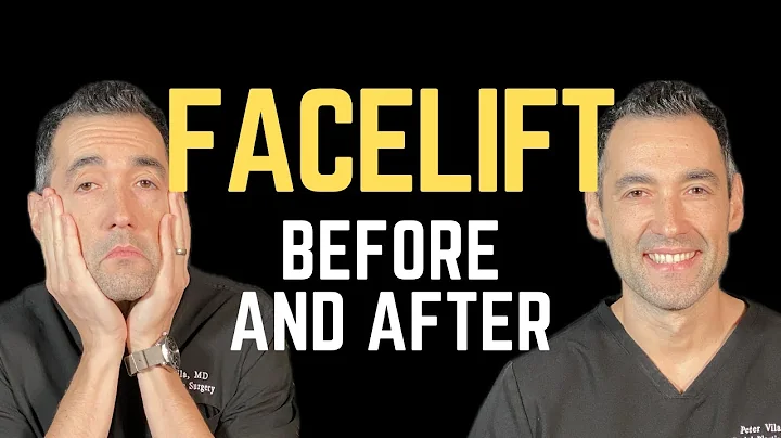 Deep Plane Facelift Before and After in Portland, Oregon with Dr. Vila, Facial Plastic Surgeon