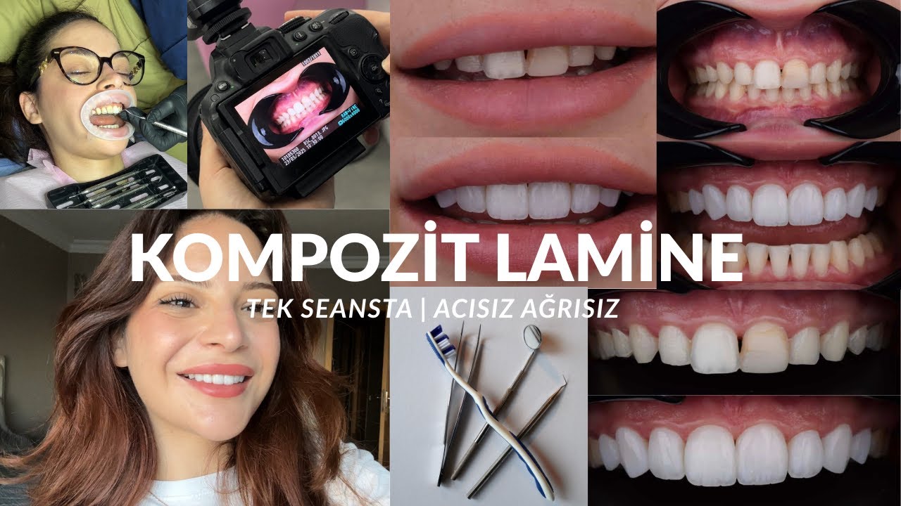 Kompozit Lamine Yaptırdım | acısız ağrısız tek seansta
