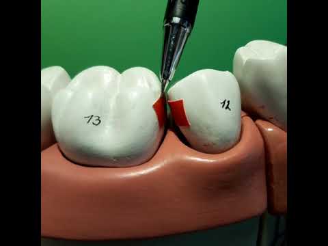 Approximal - Interdental