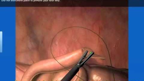 SIMTICS Medical Simulation Showcase - Laparoscopic Appendectomy