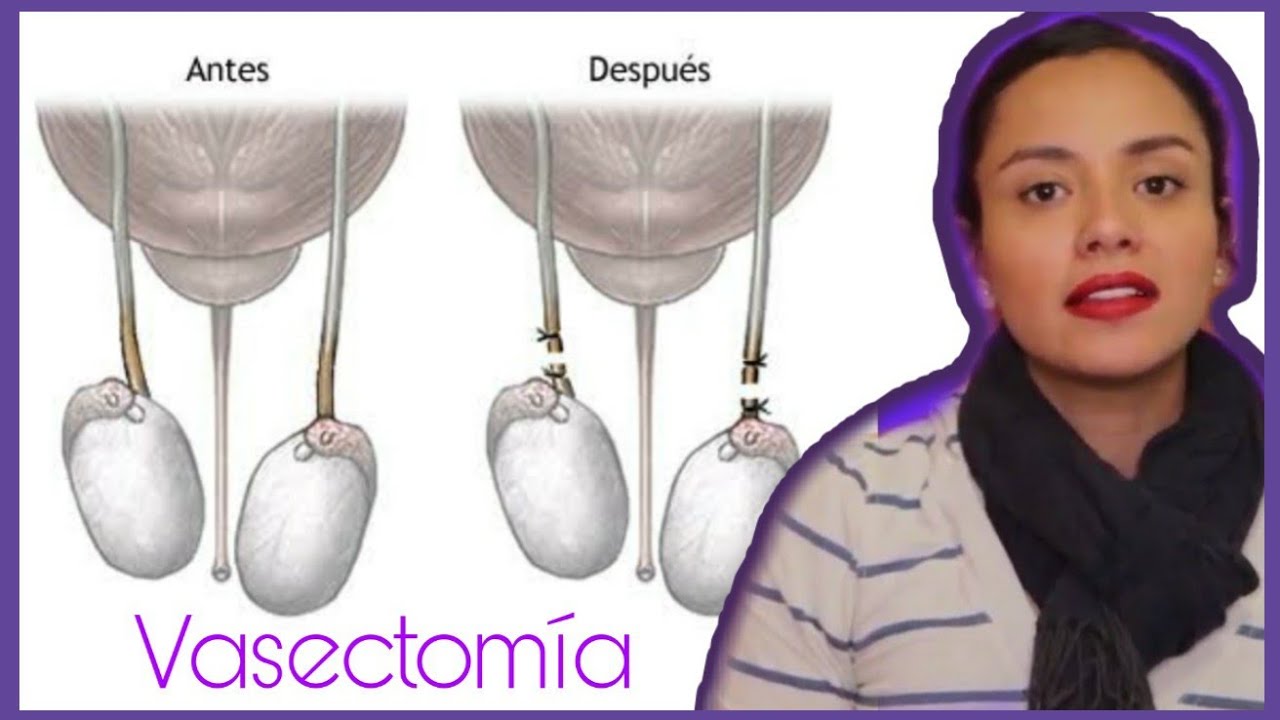 VASECTOMIA ESTERILIZACI N MASCULINA SIN BISTUR YouTube