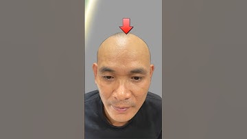 Trông anh ấy thế nào sau xăm tóc mọi người?  Scalp vietnam vnscalp ,