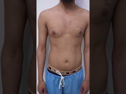 Gynecomastia Marking &