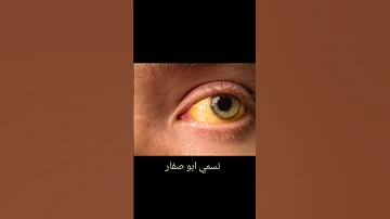 احد اعراض فقر الدم هو ابو صفار او اليرقان لماذا 