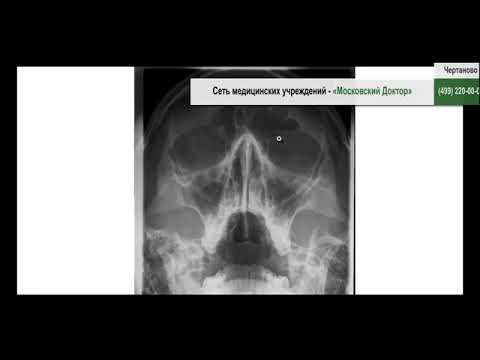 рентген пазух носа гайморит снимки. острый фронтит рентген. эмпиема придаточных пазух. эмпиема придаточных пазух.