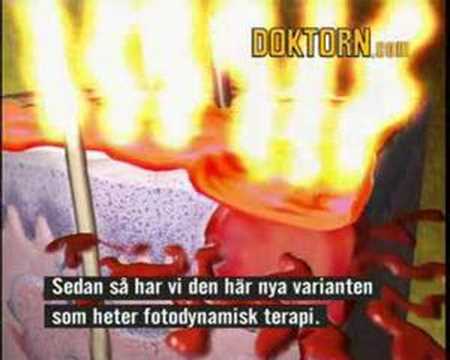 Video: Basaliom I Huden - Symtom, Behandling, Avlägsnande