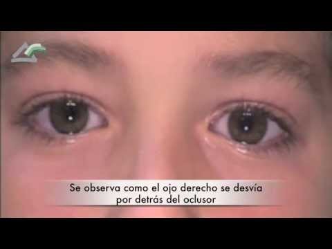 Video: ¿Cómo se obtiene la heteroforia vertical?