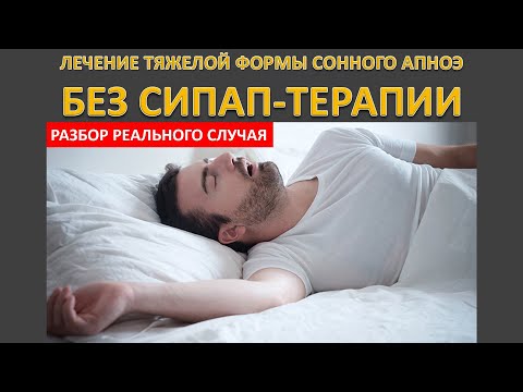 #30: Лечение тяжелой формы сонного апноэ без СИПАП-терапии | СОАС и СИПАП-терапия