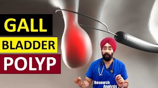 Gall Bladder Polyp | Cure & Risk of Cancer | Dr.Education Hindi Eng