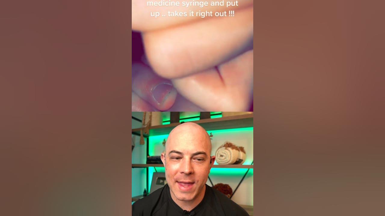 Derm reacts to failed splinter removal! #dermreacts #doctorreacts #splinter #splinterremoval