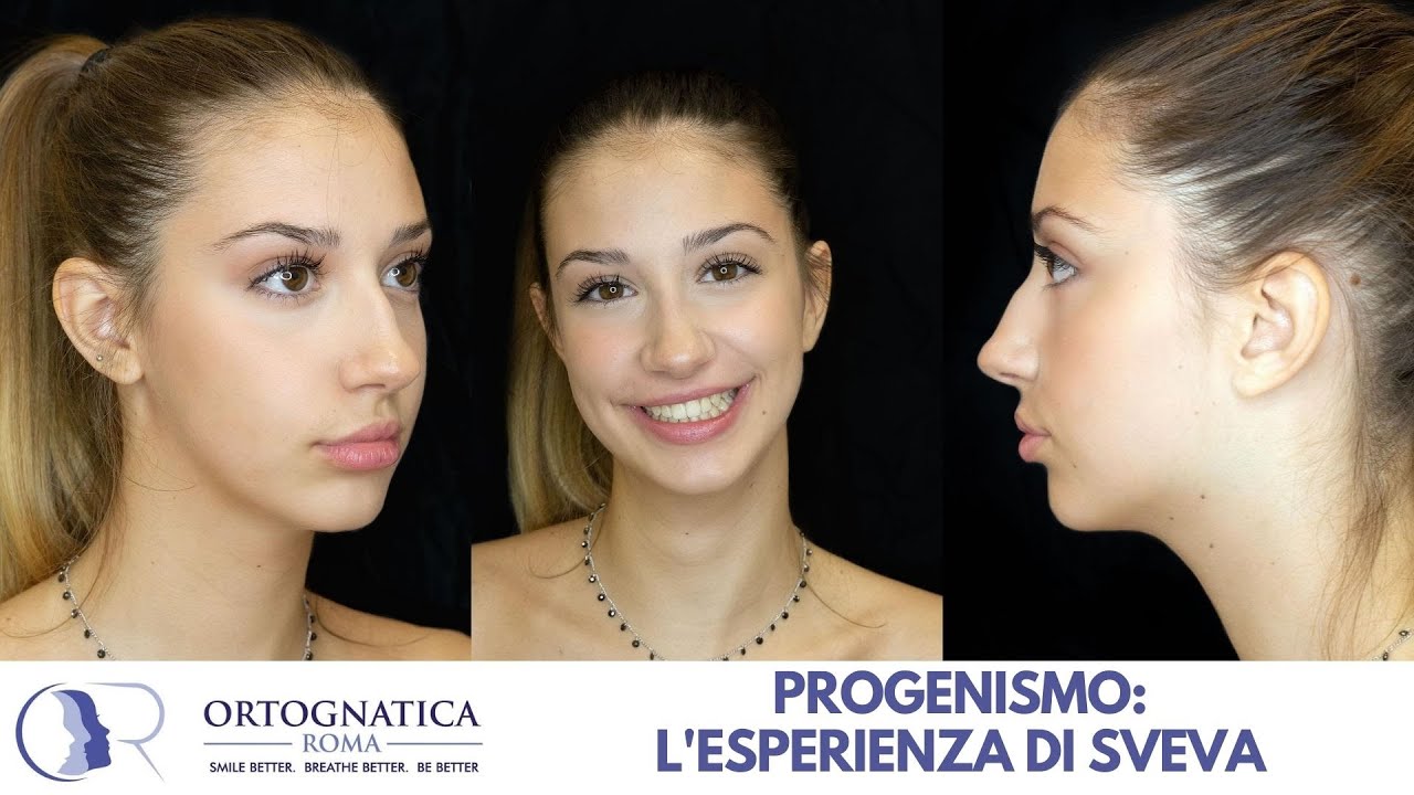 Progenismo: l'esperienza operatoria di Sveva