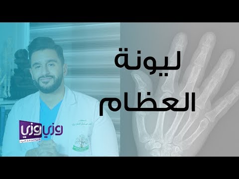 فيديو: ما هو علاج لين العظام؟