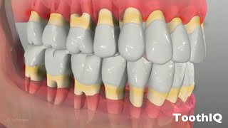 Periodontal Disease (1080p)