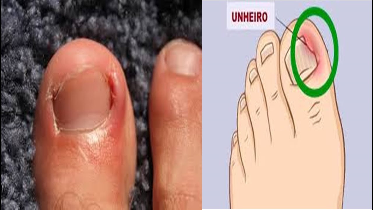 Como tratar micose de unha (unheiro) em casa? - YouTube