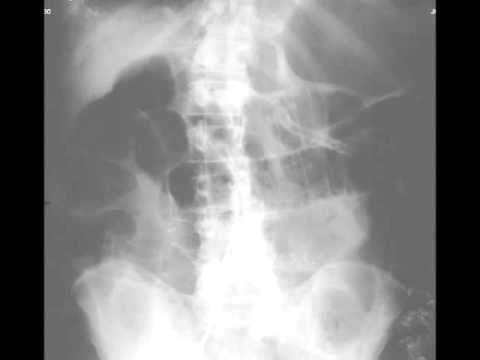 Portal Venous Air on X ray