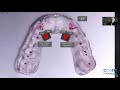 Férulas oclusales: su diseño y ajuste (2ª Parte) | Dr. Vicente Jiménez