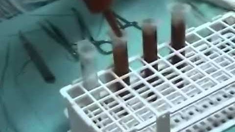 Facial Rejuvenation with Staged Injections of Cryopreserved Fat and Tissue "Cocktail"