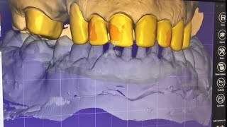 Full arch designing on exocad.. تصميم اكسوكاد