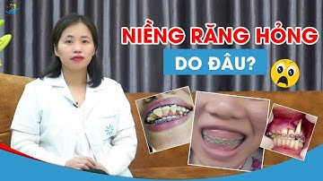 Niềng răng thất bại do đâu || Cách né tránh thảm họa niềng răng hỏng
