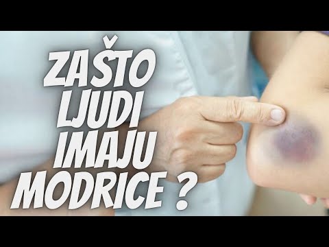 Video: Modrice Koje Neće Nestati: Uzroci, Zabrinutosti, Liječenje I Još Mnogo Toga