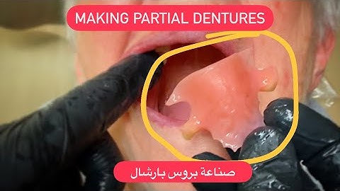 MAKING PARTIAL DENTURE WITHOUT CLASPS . صناعة بارشال ٣ اسنان #WAXBAE