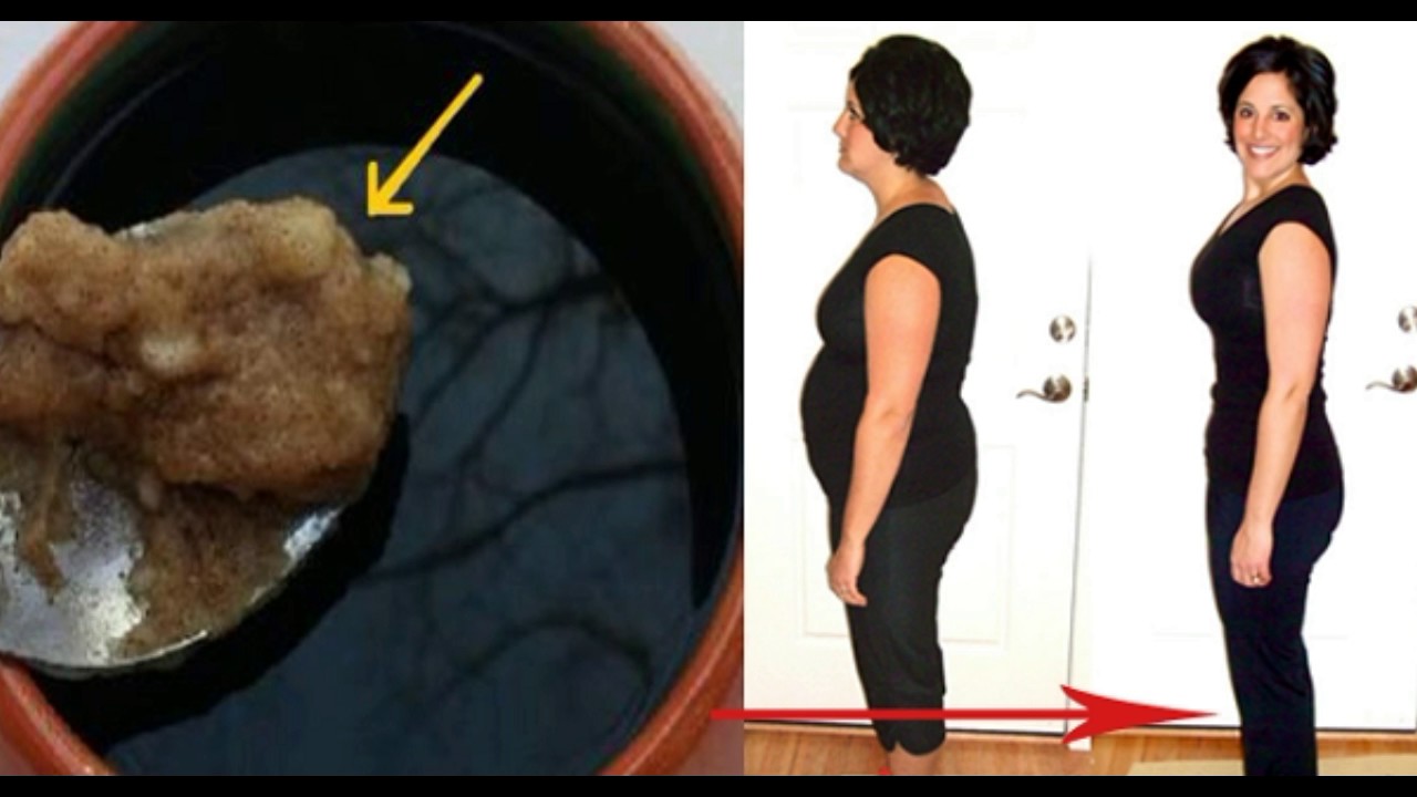 Ожирение внутренних органов. Как выглядит жир в теле. Подкожные жировые отложения. Как выглядит жир в теле. Подкожные жировые отложения.