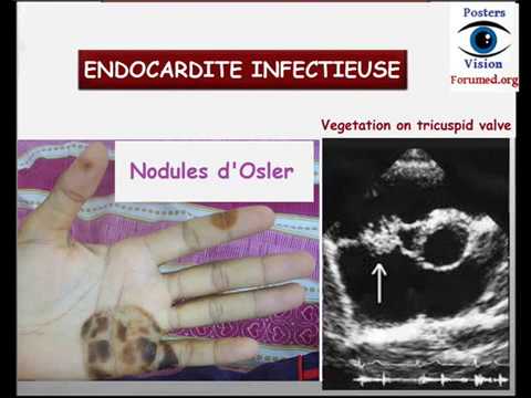 Endocardite infectieuse d'osler bactérienne et Prophylaxie des  cardiopathies à risque cours cardio